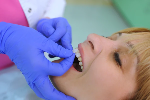 veneers-in-oakville Cosmetic Dentistry in Oakville
